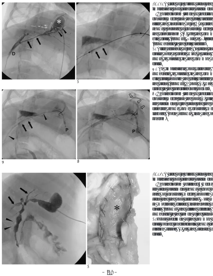 Fig. 2. A case of a biliary stent and an implantable port catheter placement.
