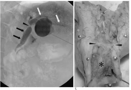 Fig.  3. A case of a biliary stent place- place-ment without an implantable port catheter.