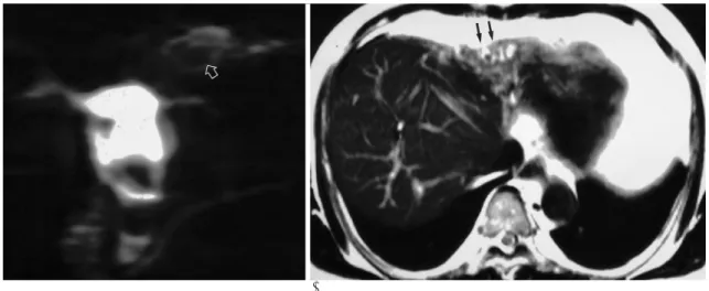 Fig. 4. Hepatolithiasis in left lobe in a 48-year-old man