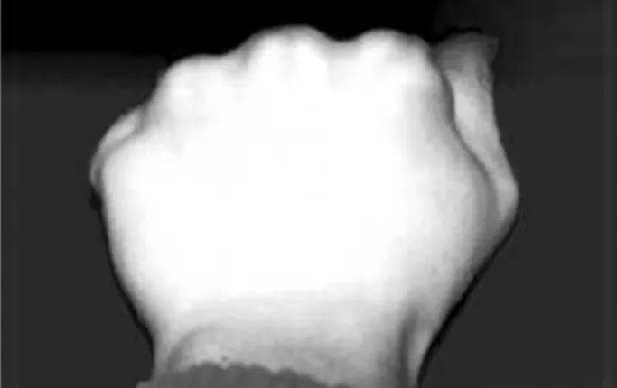 Table 1. Angulation of fracture site in operative and conser- conser-vative groups (pre treatment)