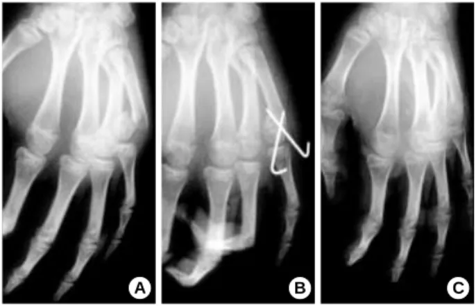 Fig. 3. The correction of angulation after operation is well main- main-tained. (A) Preoperative radiograph showed 46° angulation