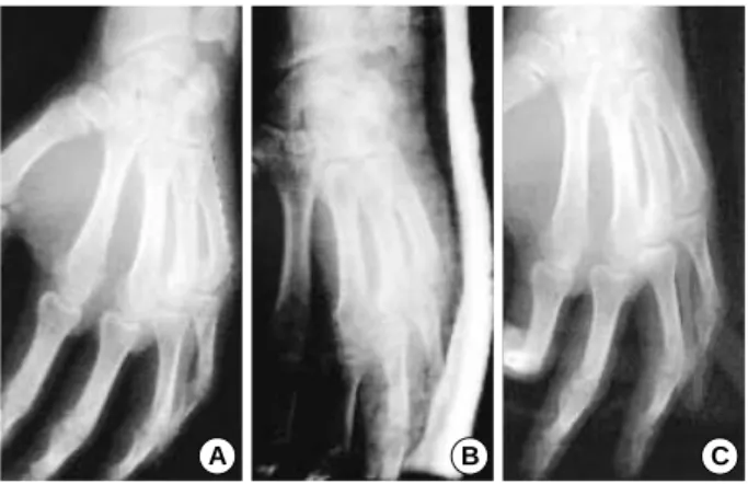 Fig. 4. The correction of angulation after closed reduction and cast is not maintained
