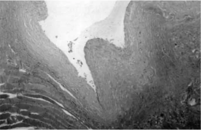 Fig. 2. (A) Axial T1-weighted MR image showing a lobulated mass of low signal intensity within the peroneus longus and brevis  mus-cle