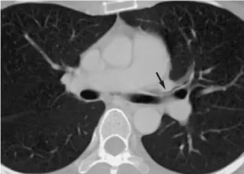 Fig. 5. Pneumothorax in a 46-year-old man with multiple large bullae. Chest CT scan through upper thorax show multiple large bullae on both sides (asterisks)