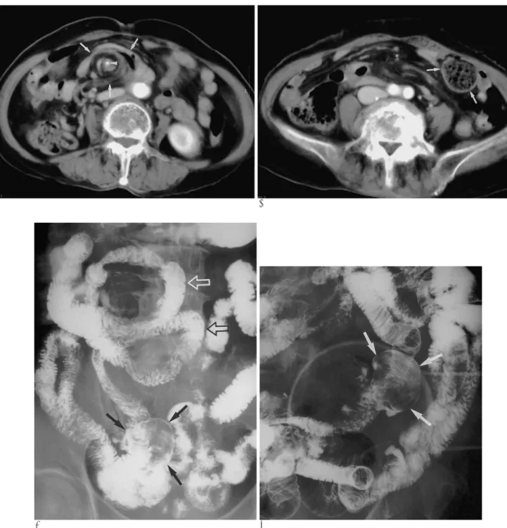 Fig. 1. Midgut volvulus associated a large small-bowel diverticulum in a 77-year-old woman.