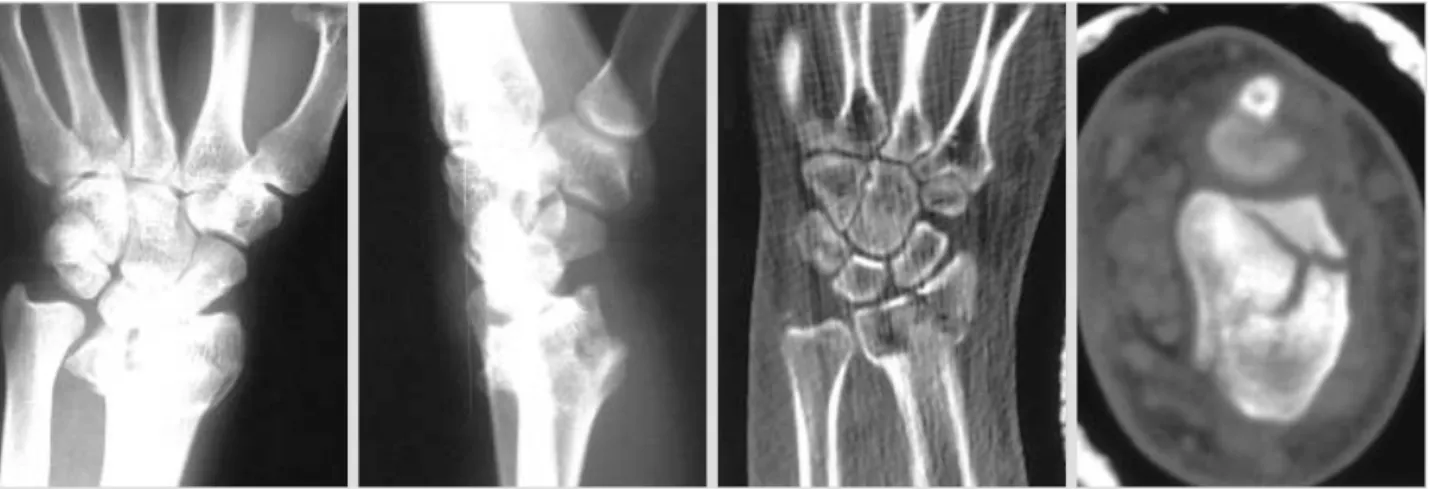 Fig. 1. Plain radiograph of 19-year-old man showing distal radius fracture. CT shows the split lunate facet.