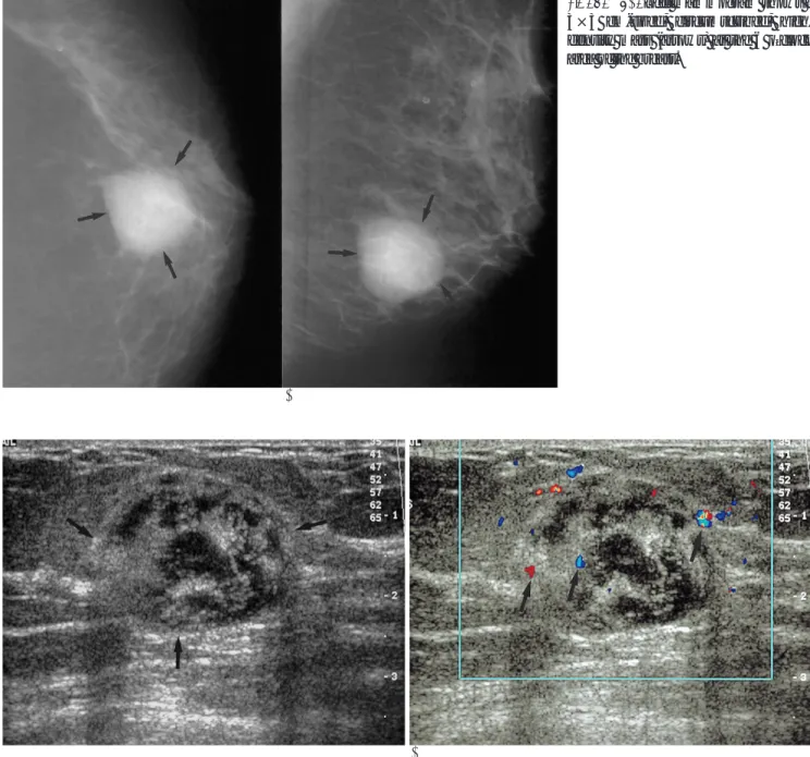 Fig. 1. A, B. Left mammogram shows a 3×3 cm-sized, circumscribed,  high-density mass (arrows) at the 6 o’clock area of the breast.