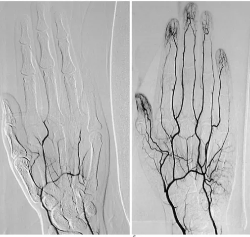 Fig.  3. Hand arteriograms are shown.