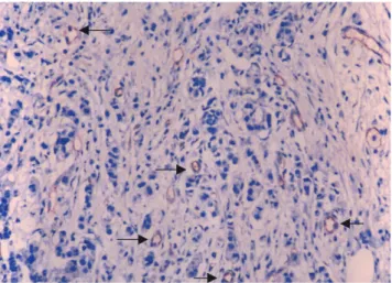 Fig.  1. Photomicrograph shows multiple microvessels (ar- (ar-rows), which are immunostained for factor VIII-related  anti-gen (×200).
