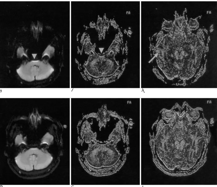 Fig. 2. Reduction of magnetic susceptibility artifact with SENSE.