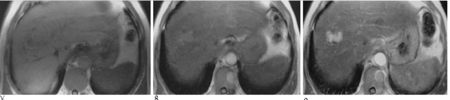 Fig. 3. Hepatocellular carcinoma. 