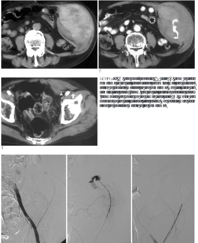 Fig.  1. Pre- (A) and post-enhanced CT scan (B) show a large hematoma in the left anterolateral abdominal wall and  extrava-sation of contrast material in the hematoma