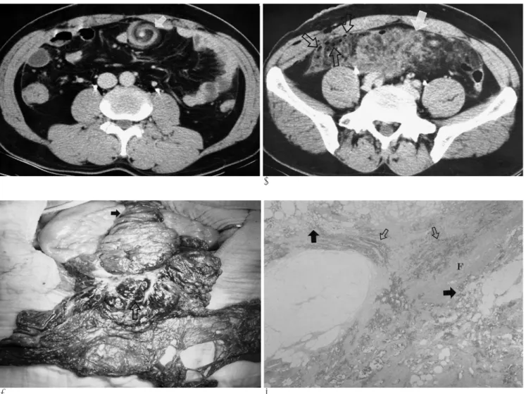 Fig. 1. A. Contrast-enhanced CT section of the mid-abdomen demonstrating a whirling patterned greater omentum with an inner high-density vascular structure (arrow).