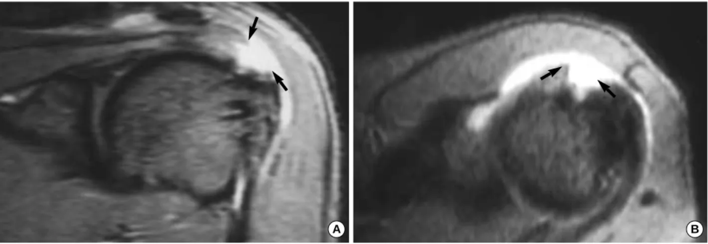 Fig. 1. Oblique coronal (A) and axial MRI scans (B) showed a 12×10 mm-sized defect at the insertion site of the supraspinatus ten- ten-don, which was observed as a high signal intensity lesion (arrows) on T2-weighted gradient echo image