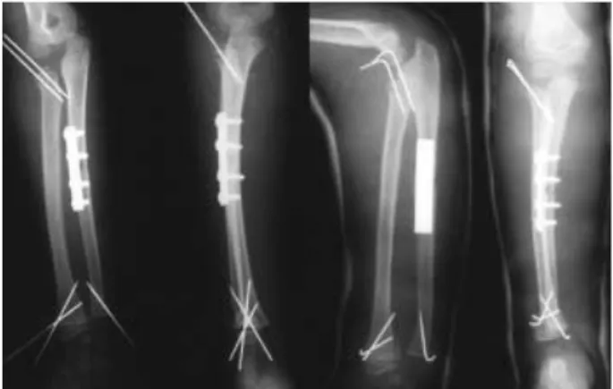 Fig. 3. Two years after surgery, radiographically, bone was well united without any residual deformity.