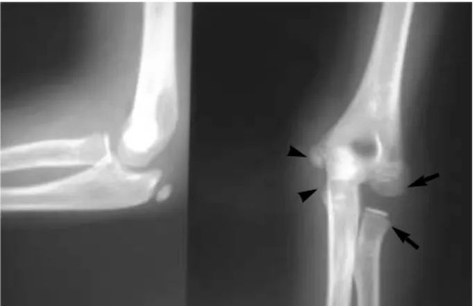 Fig. 1. Initial radiographs were read as a posterior dislocation of the elbow.