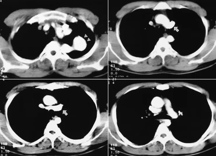 Fig. 2. Contrast-enhanced CT shows a tortuous fusiform dilated transverse arch aneurysm (arrowheads)