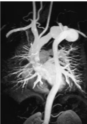 Fig. 4. MR angiography shows a tortuous dilated transverse aortic arch aneurysm. The ascending aorta reveals a normal configuration, and the size of the descending aorta revealed a small diameter.