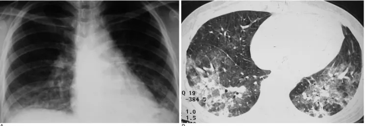 Fig. 2. Acute lupus pneumonitis in a 21-year-old woman with SLE.