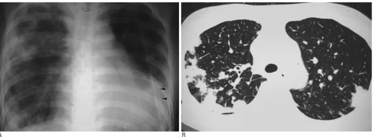 Fig. 4. Bronchiolitis obliterans organizing pneumonia in a 24- 24-year-old woman with SLE and lupus cardiac disease.