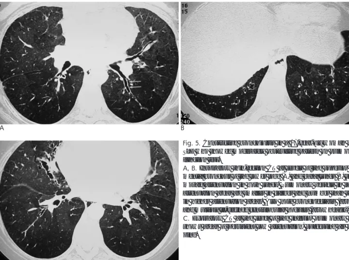Fig. 5. Constrictive bronchiolitis in a 17-year-old woman with SLE who showed moderately obstructive pattern on pulmonary function test.