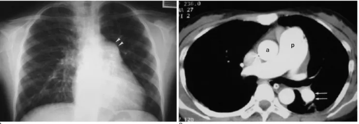 Fig. 8. Pulmonary arterial hypertension in a 16-year-old woman with SLE.