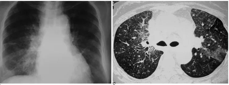 Fig. 13. Miliary tuberculosis in a 58-year-old woman who had been taking steroid therapy for SLE for 6 months.