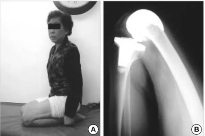 Fig. 1. A 68-year old female could flex her operated left knee 144° (A) and full flexion lateral x-ray (B).