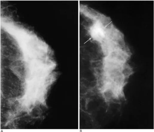 Fig. 1. A 55-year-old woman with in- in-vasive ductal carcinoma in the left breast.