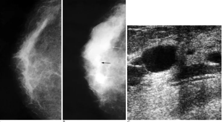 Fig. 2. A 54-year-old woman with fibrocystic change in the right breast.