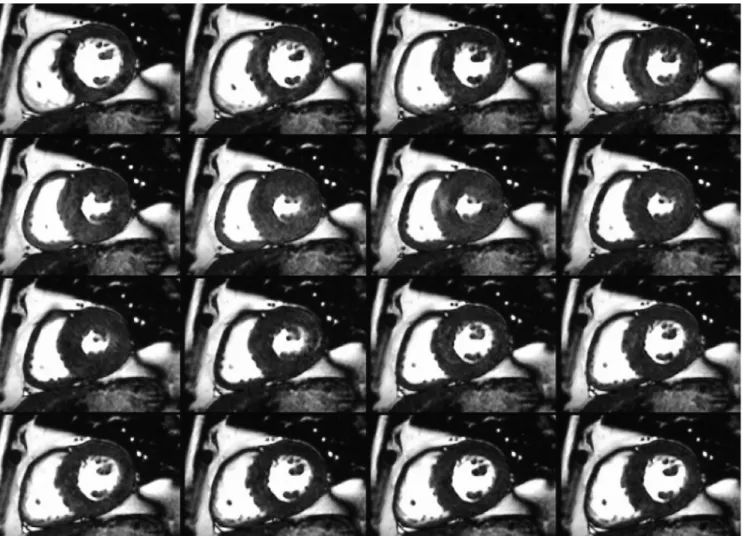 Fig. 2. 48-year-old man with chest pain and left ventricular hypertrophy.