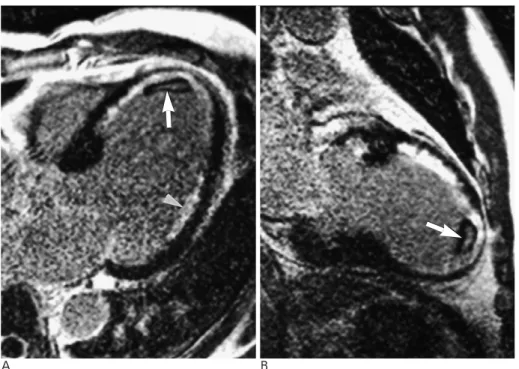 Fig. 4. 45-year-old man with acute my- my-ocardial infarction.