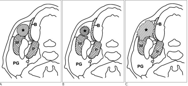 Fig. 1. Representative schema of the buccal space lesion.