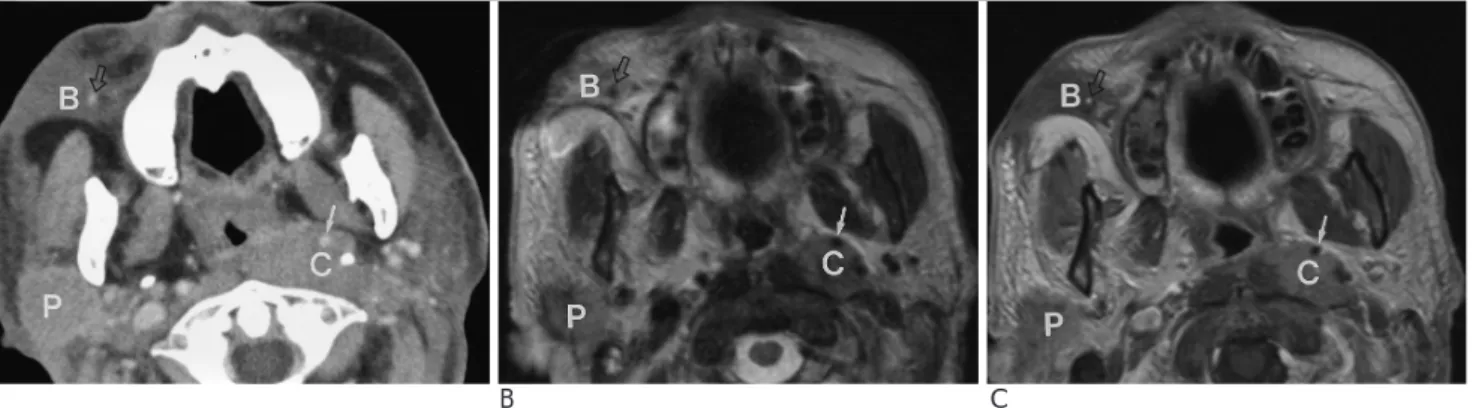 Fig. 4. A 53-year-old woman with peripheral T-cell lymphoma.