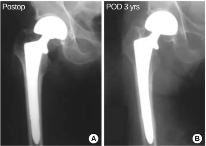 Fig. 2. The radiographs show the bipolar hemiarthroplasty with AML stem in 77 years old man