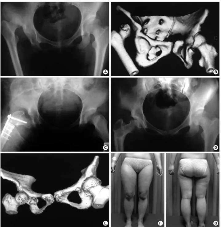 Fig. 1. (A) Both hip AP radiography of 17-year-old patient shows dislocated right femoral head