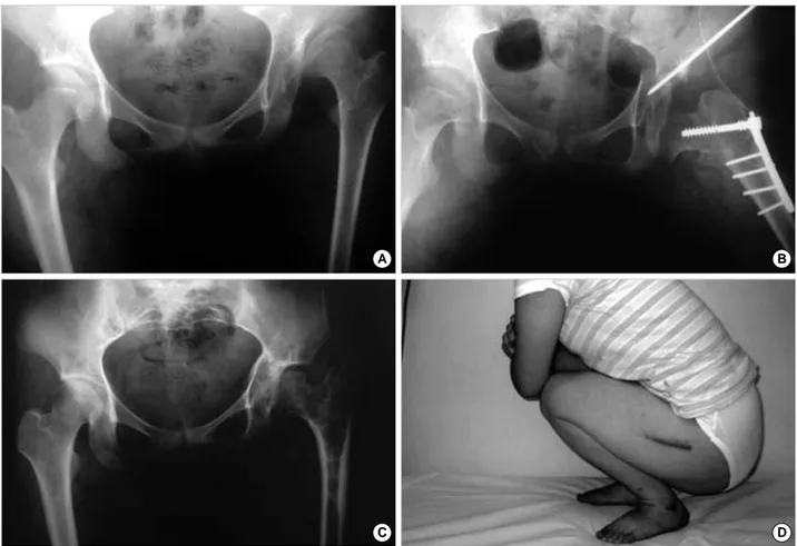 Fig. 2. (A) Both hip AP radiography of 14-year-old patient shows dislocated left femoral head