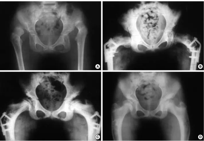 Fig. 3. (A) Both hip AP radiography of 8-year-old patient shows dislocated both femoral head