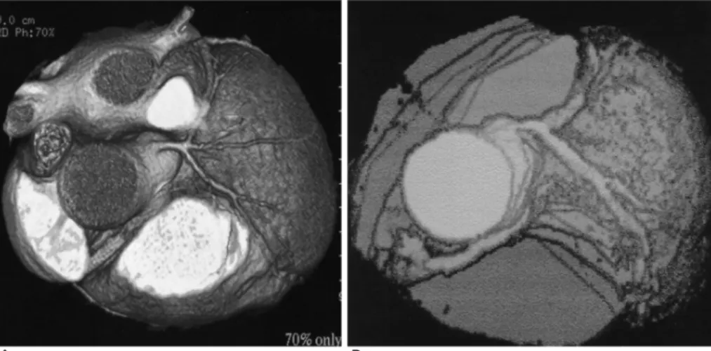 Fig. 2. Optimizing window of retrospectively ECG-gated re- re-construction. Absolute time delay from the R-peak (A) or  per-centage of R-R interval (B) can be set for image reconstruction.