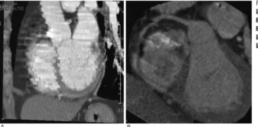 Fig. 3. Motion artifact due to fast heart rate. Step-like motion artifact is noted along the Z-axis in 4-detector CT (A) and 16-detector CT (B)