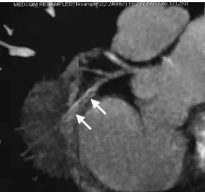 Table 1. Diagnostic Accuracy of Coronary CT Angiography with 16-detector CT to Detect Significant Stenosis