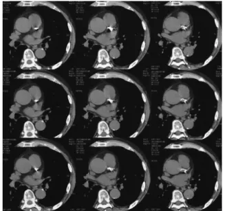 Fig. 8. Coronary artery calcium scoring. Noncontrast prospec- prospec-tive ECG-gated images by multislice CT show dense  calcifica-tions in proximal left coronary artery.