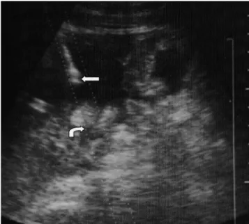 Fig. 1. This US picture shows an 18-gauge Chiba needle insert- insert-ed along a US biopsy guide (curvinsert-ed arrow) into an abdominal abscess cavity