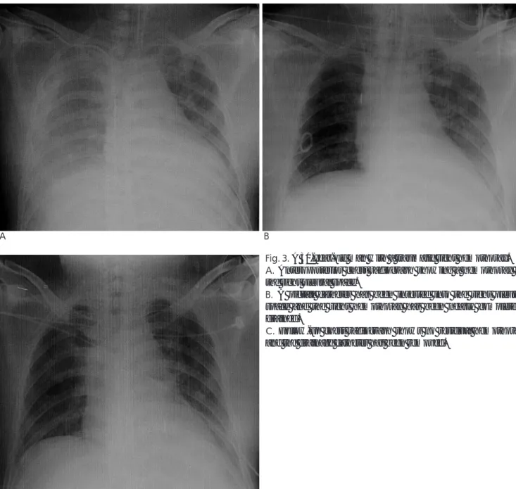 Fig. 3. A 30-year-old man with a traumatic right hemothorax.