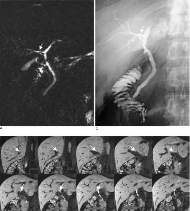 Fig. 1. Right posterior segmental duct to left hepatic duct pattern.