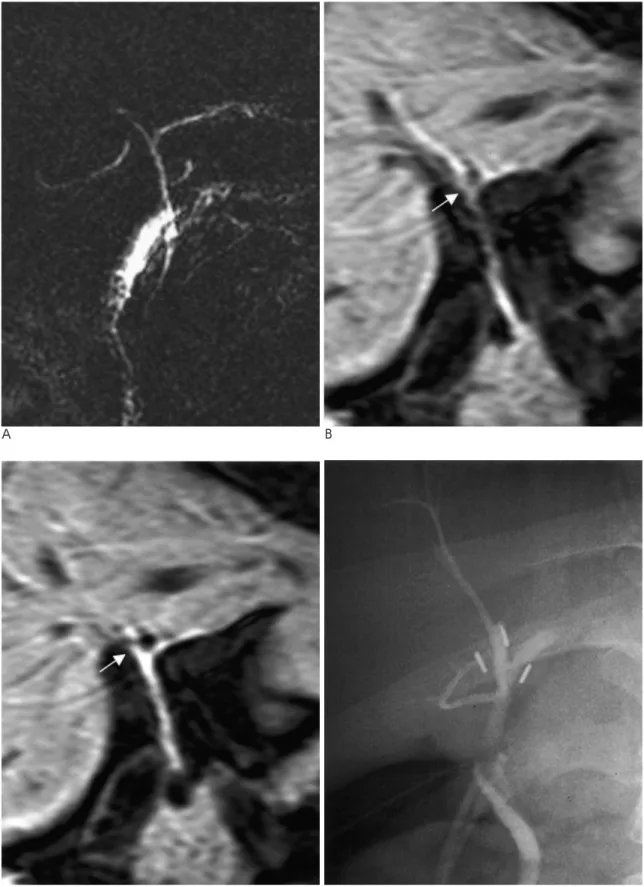 Fig. 2. Unfavorable trifurcation pattern that single anastomosis cannot be performed. 