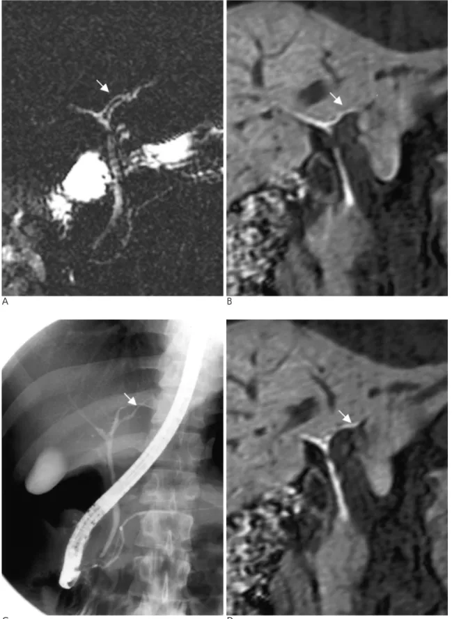 Fig. 3. Left lateral segmental duct to right hepatic duct pattern.