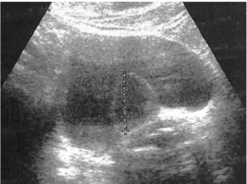 Fig. 2. CT scan reveals a homogenously enhancing mass in- in-volving bladder wall.