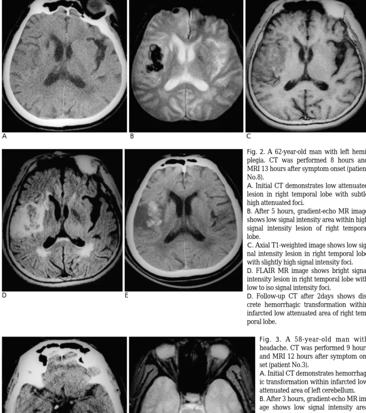 Fig. 2. A 62-year-old man with left hemi- hemi-plegia. CT was performed 8 hours and MRI 13 hours after symptom onset (patient No.8).