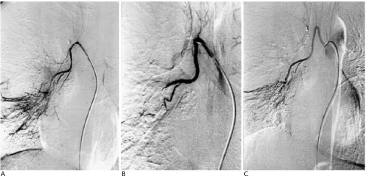 Fig. 2. Angiograms showing recurrence of hemoptysis from the same artery.